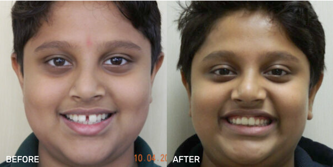 Before After