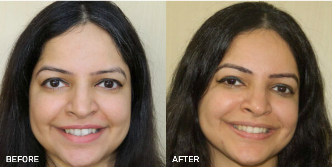 Before After