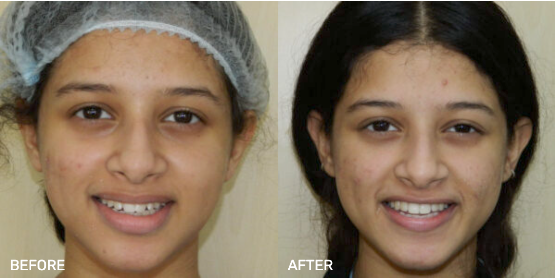 Before After