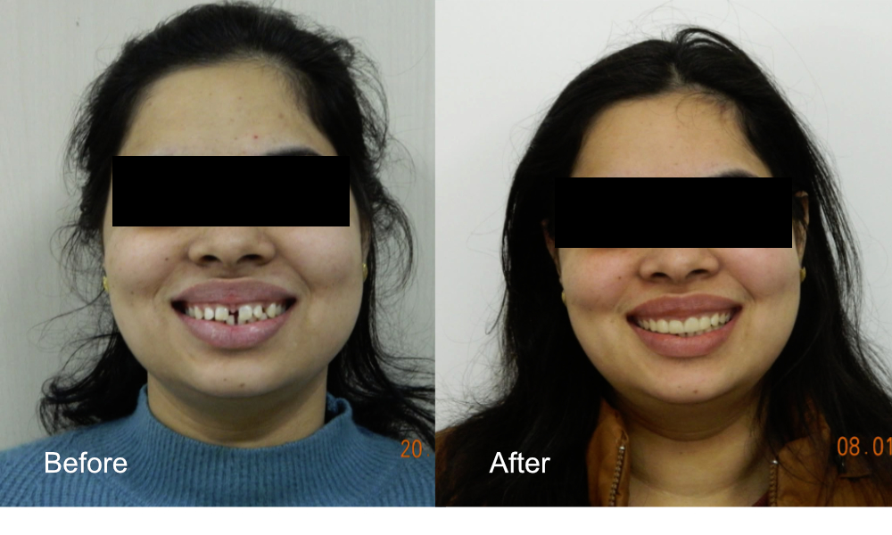 Before After