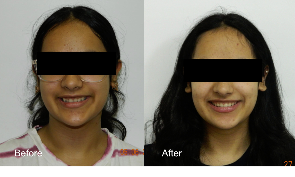 Before After