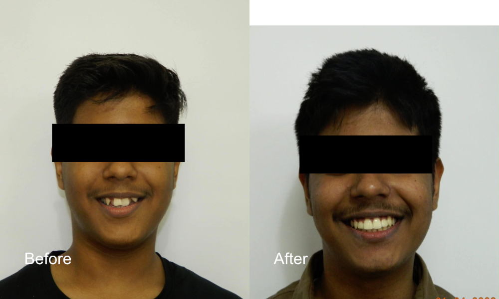 Before After