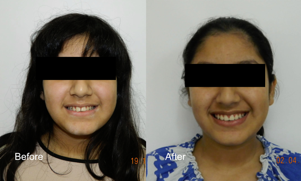 Before After